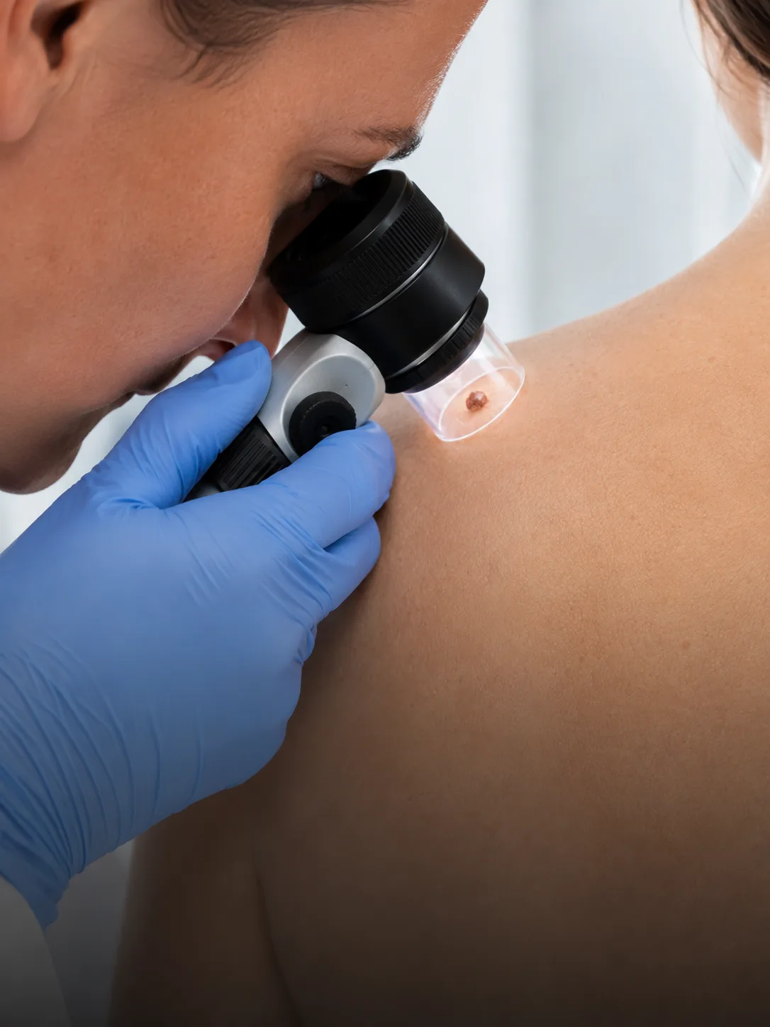Dermatóloga examinando un lunar con dermatoscopio